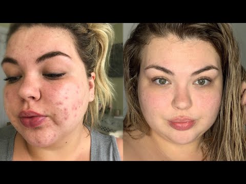 How To Get Rid Of Acne Scars!