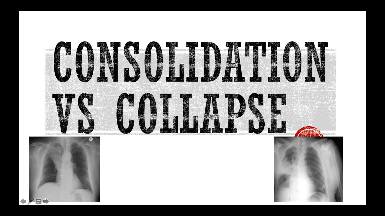 How to differentiate consolidation from collapse in a Chest Xray YouTube