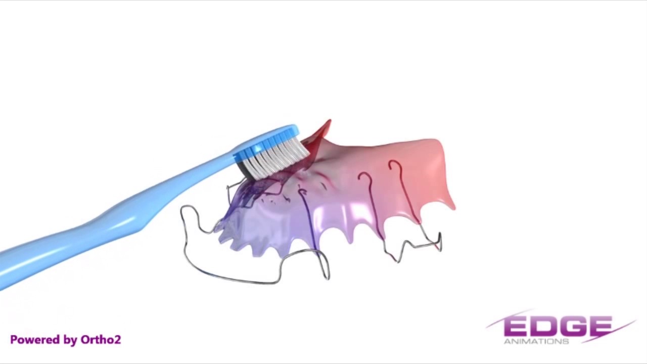 Retainers Blackburn Orthodontics YouTube