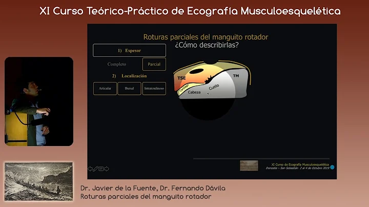 2019 Roturas Parciales del manguito rotador