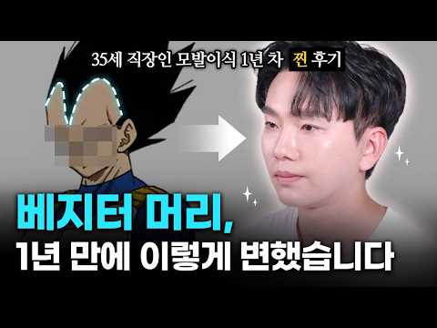 베지터 같았던 M자 이마, 1년 만에 이렇게 변했습니다!