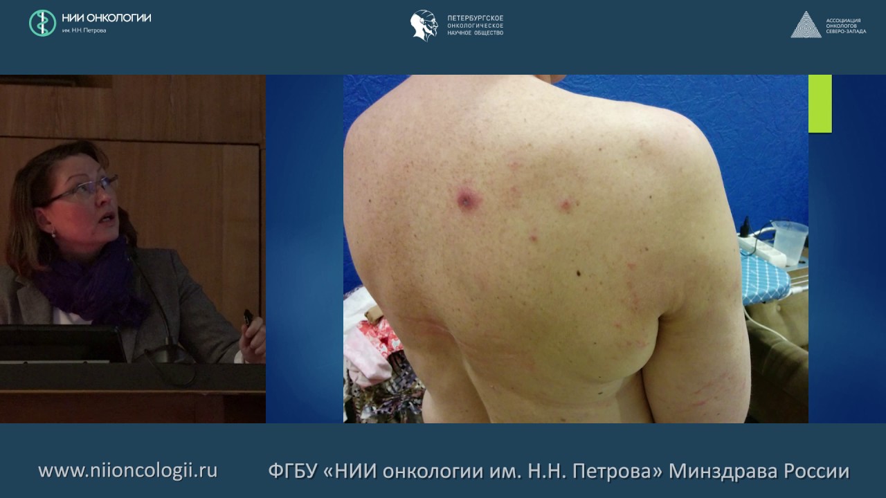 Клинический опыт применения Винорелбина в капсулах в Республике Карелия