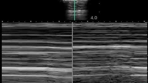 No Lung Sliding with M Mode Linear Transducer