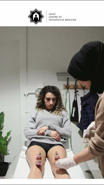 Wet Cupping (Hijama) Therapy for Knee Pain!