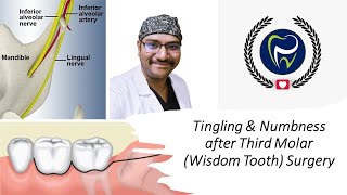 Dr Rudra| I have numbness after my wisdom tooth surgery! Paraesthesia after Wisdom Tooth removal