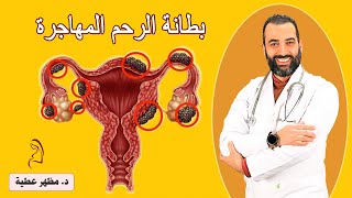 ما هي بطانة الرحم المهاجرة وتأثيرها على الحمل وطرق علاجها . دكتور مظهر عطية