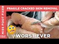 THIN and FRAGILE callus removal, callosity removal, hard skin removal by miss foot fixer marion yau