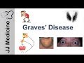 Graves Disease and Graves Ophthalmopathy | Signs, Symptoms, Diagnosis and Treatment