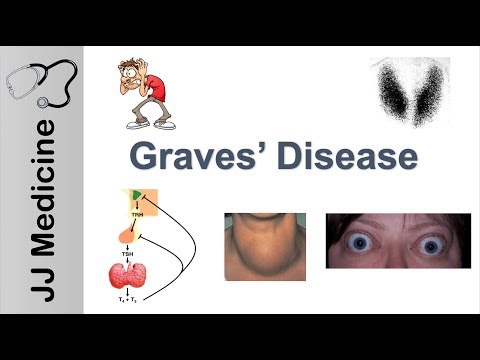 ग्रेव्स डिजीज एंड ग्रेव्स ऑप्थल्मोपैथी | लक्षण, लक्षण, निदान और उपचार