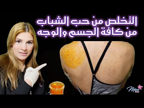 لجسم صافي متل الحليب التخلص من حبوب الجسم والظهر والمؤخرة والصدر والذراعين واثارها