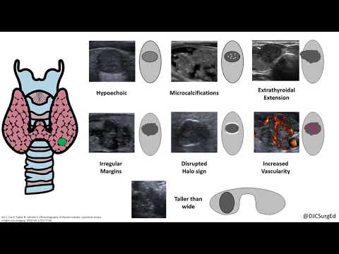 Thyroid Nodules