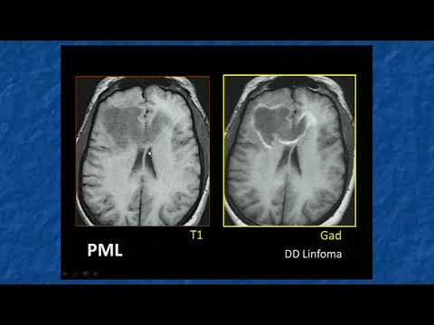 Video: Il recupero da un intervento chirurgico ti rende immunocompromesso?