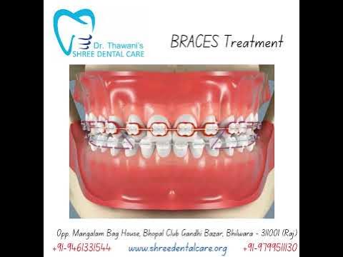 Braces video #dental wiring - YouTube
