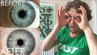 How Fasting Changed my EYES | Iridology Results