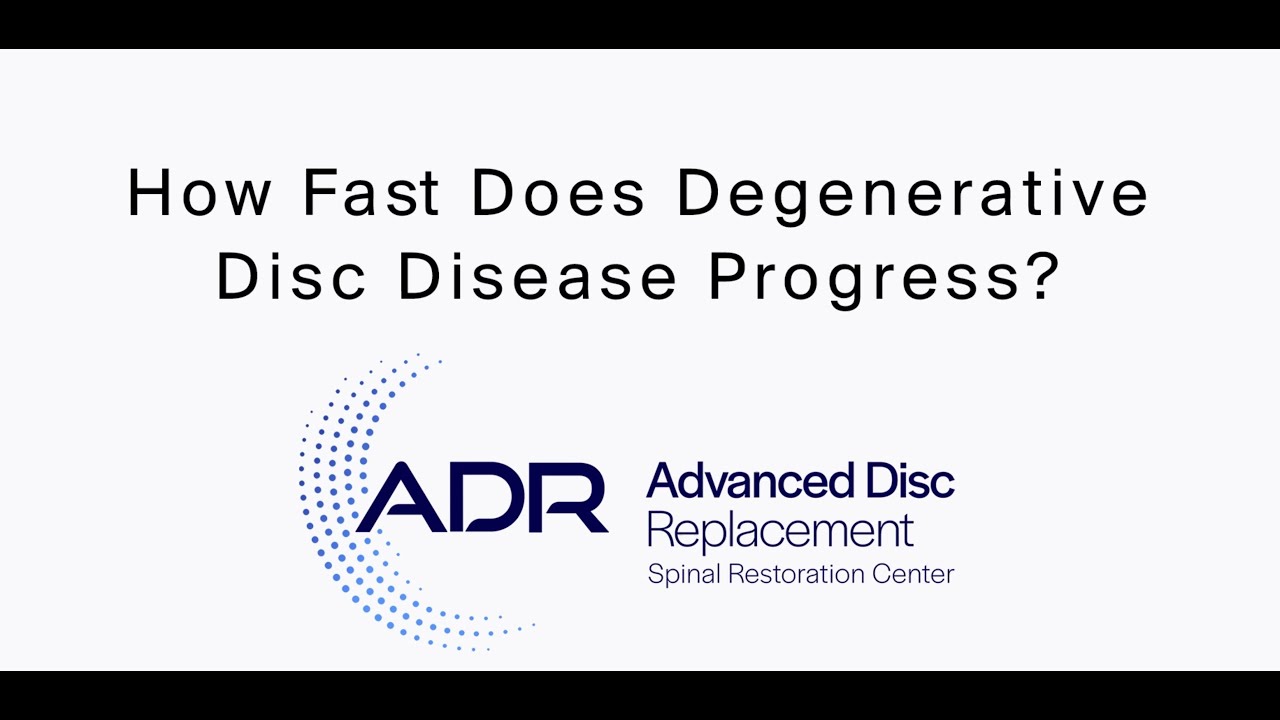 How Fast Does Degenerative Disc Disease Progress? YouTube