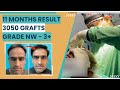 Hair Transplant in Delhi | Best Hair Transplant Results | Hair Transplant cost in Delhi | Dr Jangid