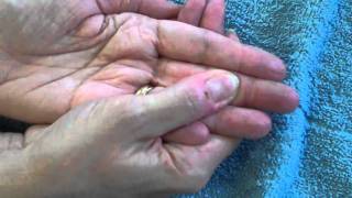 Tendon Blocking