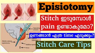 Episiotomy Malayalam│How to take care of Stitches After Normal Delivery│When to consult a Doctor