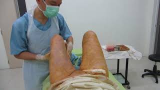Inner Thighs Liposuction MVI 9429 Inner Thighs Liposuction MVI 9429