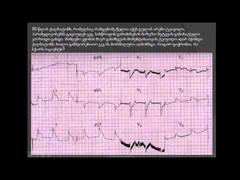 პრინცმეტალის სტენოკარდია (ვარიანტული სტენოკარდია) / კორონარული არტერიების სპაზმი / ანგიოგრაფია
