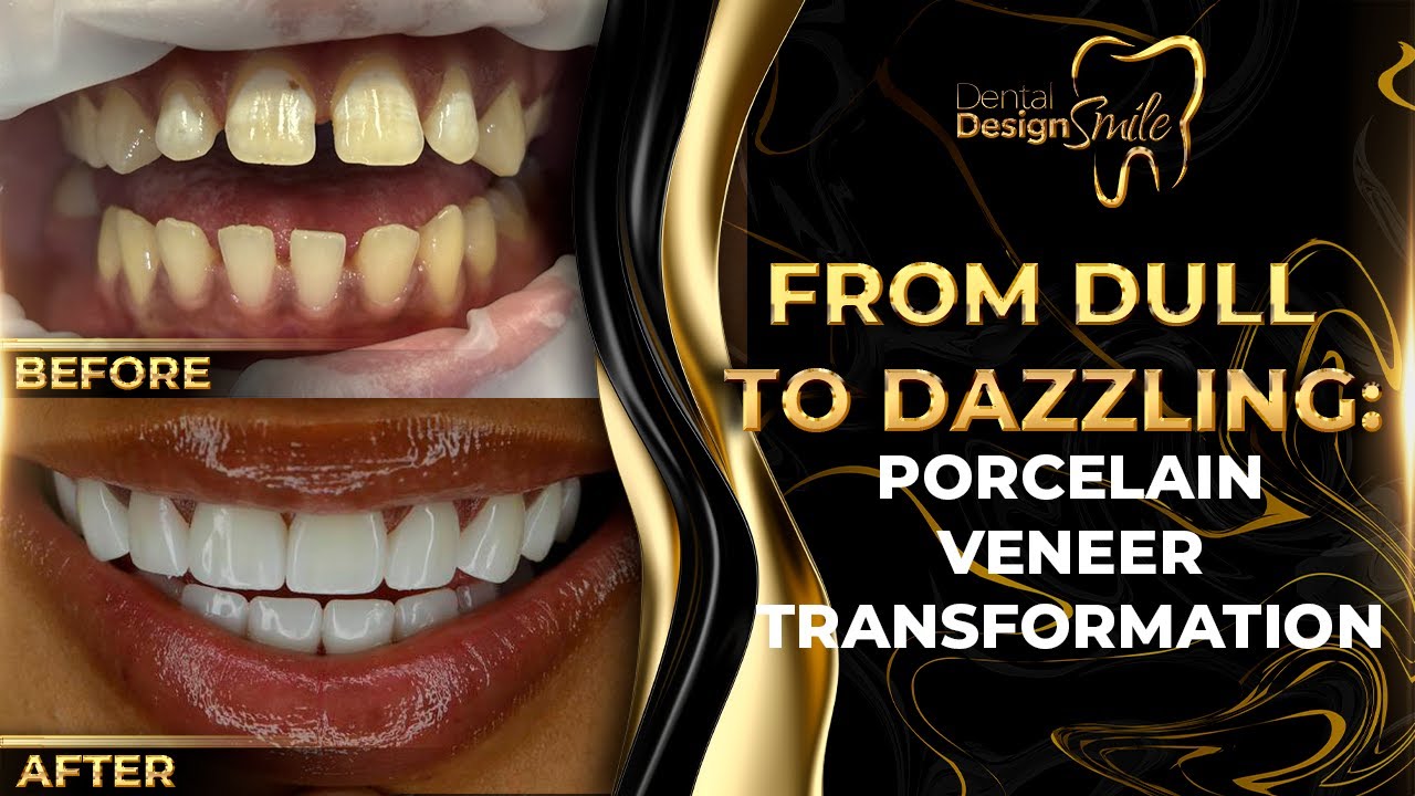From Dull to Dazzling: Porcelain Veneer Transformation