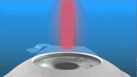 Refractive Surgery