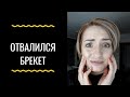 Беда. Отвалился Брекет.