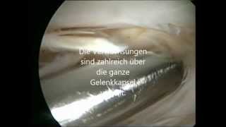 Arthrofibrose Schmerzhafte Vernarbungen Am Kniegelenk Youtube Arthrofibrose Schmerzhafte Vernarbungen Am Kniegelenk Youtube