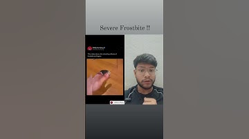 Severe Frostbite #viral #ytshorts #youtubeshorts #viralvideo #viralshorts #viralshort #facts #health