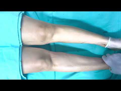 Çarpık Bacak Estetiği Crooked Leg Treatment | Op. Dr. Arda Katırcıoğlu