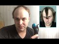 BALDING MAN Tired Of Receding Hairline Shaves Head Bald And Totally Transforms Look!