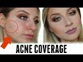 HOW TO CORRECT AND CONCEAL - ACNE/ SCAR COVERAGE
