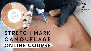 Introducing Stretch Mark Camouflage - a PMU technique