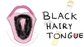 Black Hairy Tongue