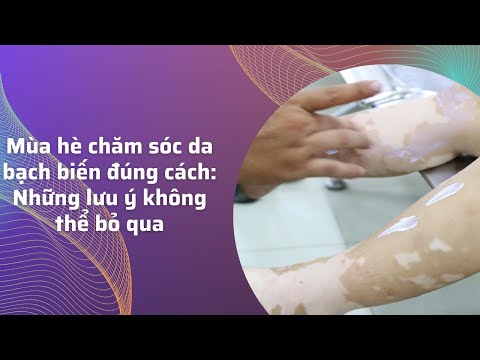 Mùa hè chăm sóc da bạch biến đúng cách: Những lưu ý không thể bỏ qua mới nhất 2023