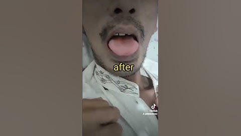 Pasien HIV dengan Kandidiasis oral + TB Paru