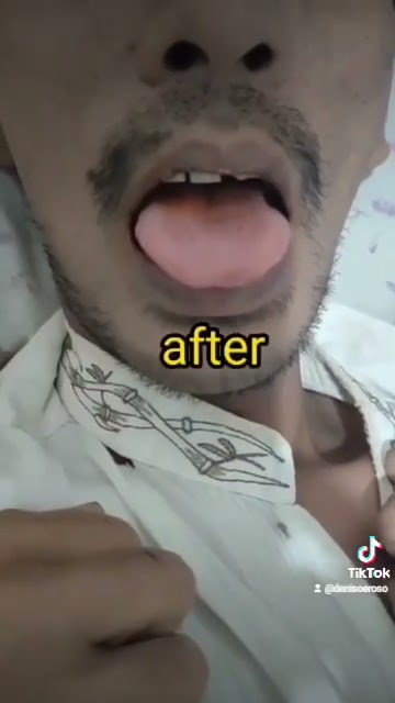Pasien HIV dengan Kandidiasis oral   TB Paru