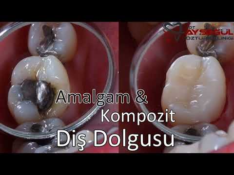 Kompozit Dolgu & Amalgam Dolgu Kıyaslama | Diş Dolguları