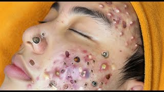 Loan Nguyen Acne Treatment specal 6