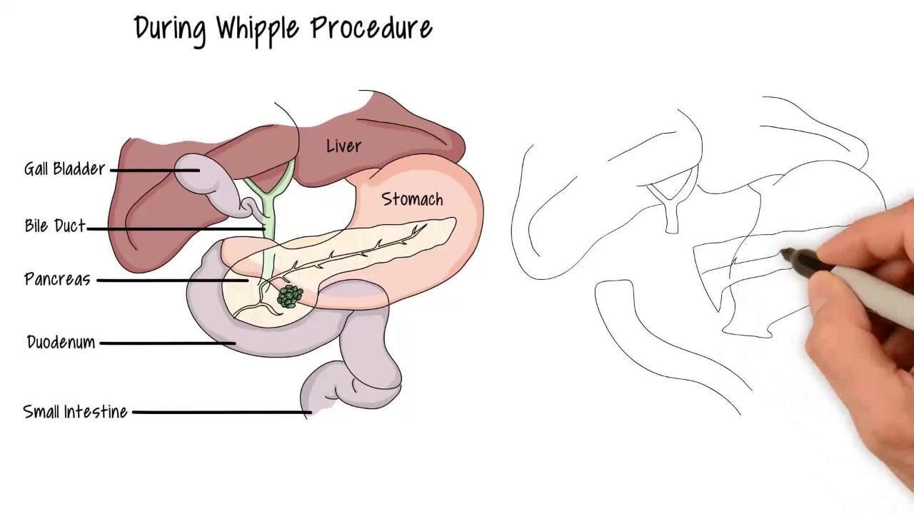 Understanding Whipple Surgery Procedure, Recovery, and Expectations
