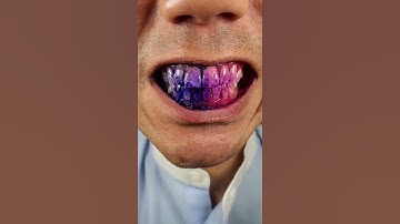 Chewing on Disclosing Tablets 🟣#DoctorTristanPeh #DisclosingTablets #ASMR #ASMRTikTok #Shorts