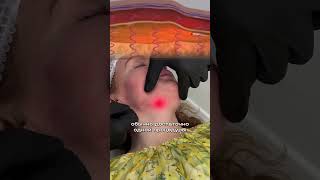 Endolift - процедура, направленная на улучшение состояния кожи, уменьшение морщин и рубцов.