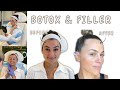 BOTOX BEFORE AND AFTER
