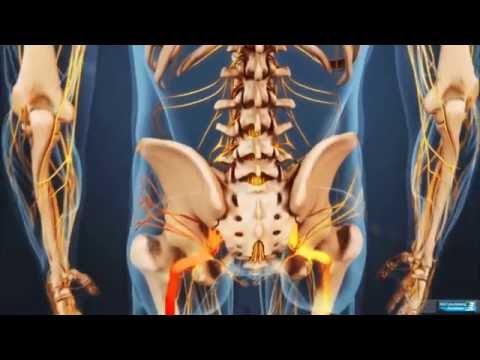 Linu Pinggul / Sciatica, linu menjalar  - Dr. Eko Agus Subagio, Sp. BS - Spine (Tulang Belakang)