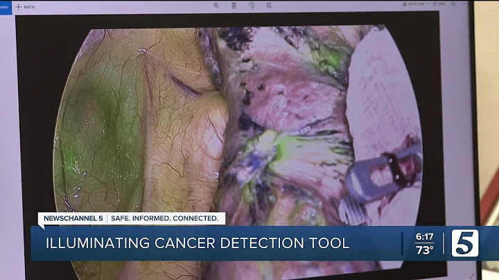 New cancer detection tool helps doctors remove lung tumors by making them glow