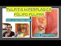 PULPITIS HIPERPLÁSICA  O PÓLIPO PULPAR - TODO LO QUE TIENES QUE SABER