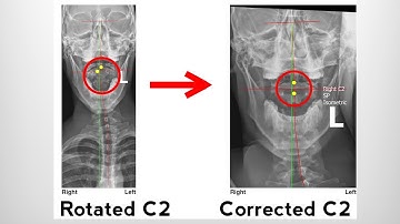 Upper Neck Rotation- Importance of the Axis Vertebrae and C2 Spinous Rotation Corrective Exercise