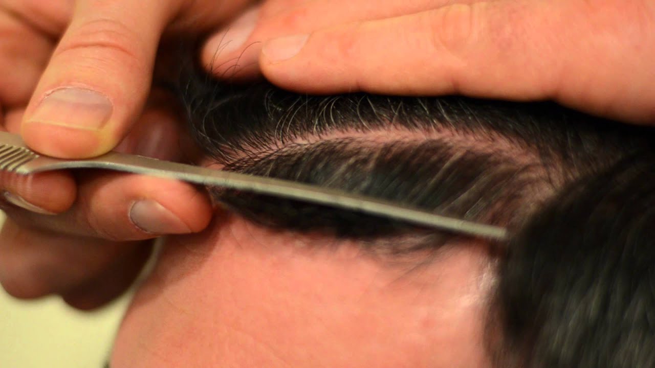 Dense Packed Megasession Hair Transplant - 1.800.859.2266