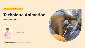 Knee Arthroscopy | Technique Animation