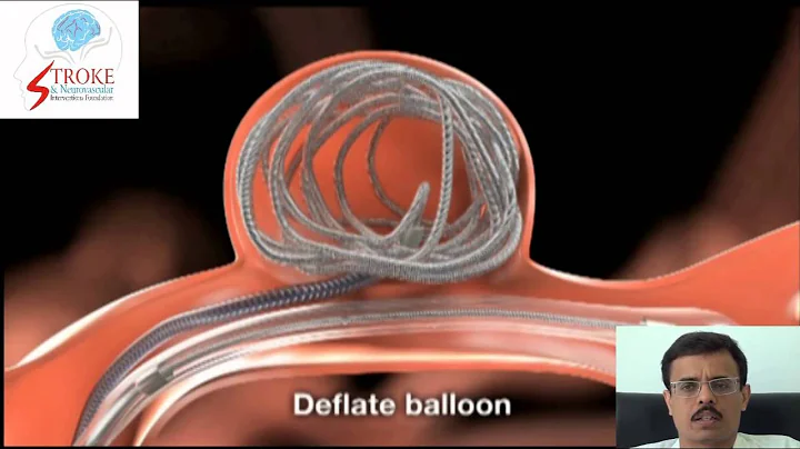 Balloon Assisted Coiling of Brain Aneurysm (Hindi)